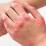 Psoriasis
