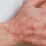 Atopic dermatitis
