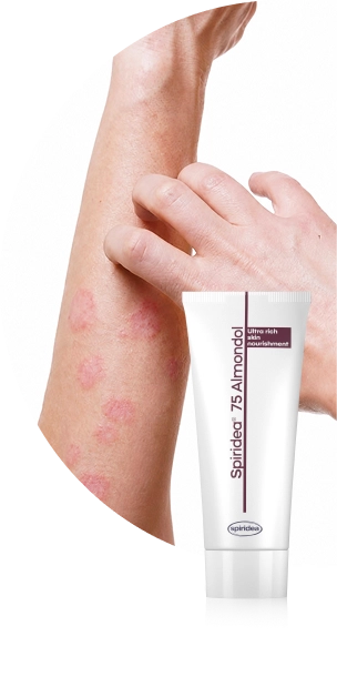 Atopic dermatitis