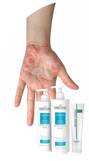 Psoriasis