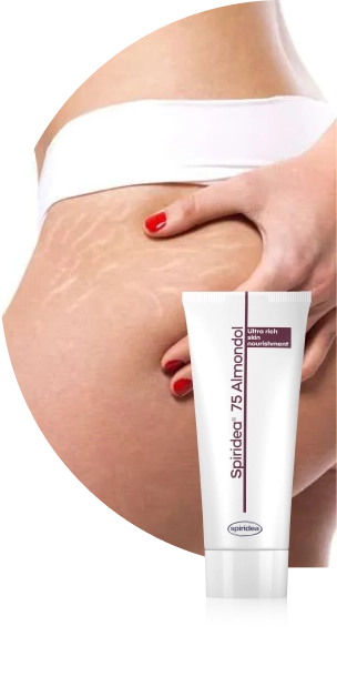 Stretch marks